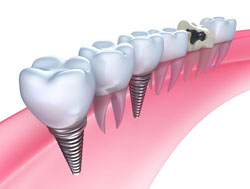 dental implants Putnam, CT
