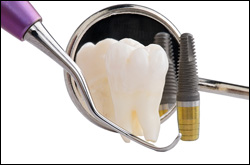 Dental Implant -  Putnam CT Dentist